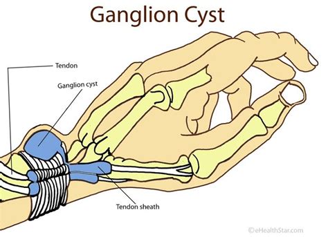 Pin On Ganglion On Upper Side Of Wrist
