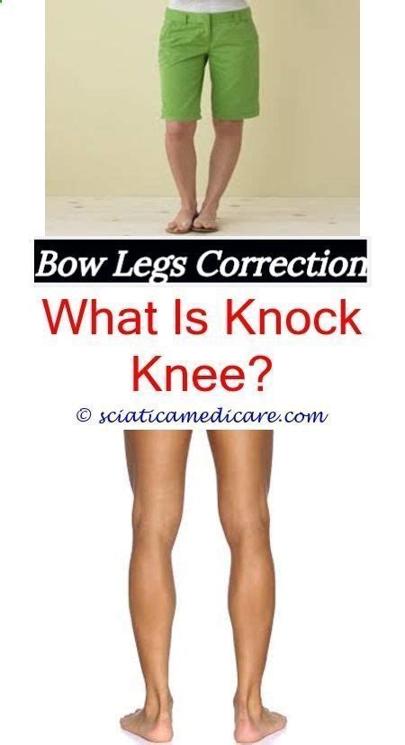 Bracket Legs How Do People Get Bow Legged Does Rickets Cause Bowed
