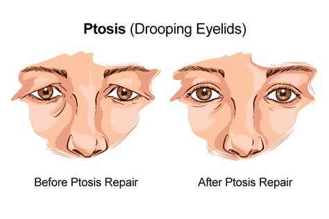 ophthalmic plastic surgery of the upper face eyelid ptosis dermatochalasis and eyebrow ptosis