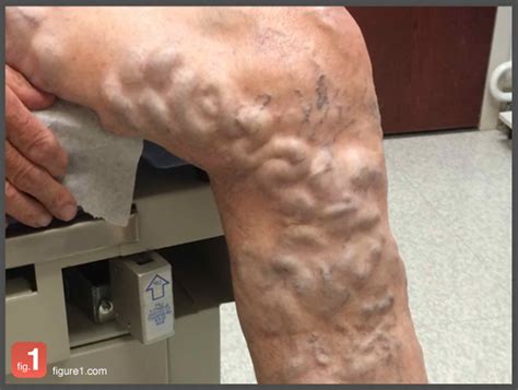 Image Of The Week Treating Severe Varicose Veins