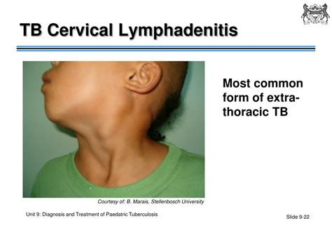 Ppt Unit 9 Diagnosis And Treatment Of Paediatric Tuberculosis