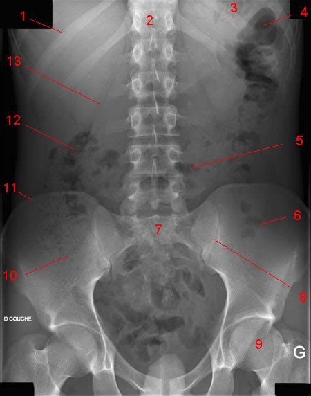 Abdominal X Ray W Radiology