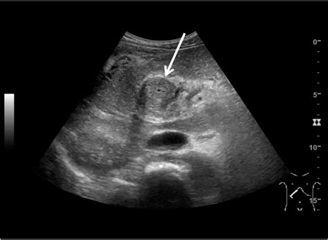 Common Bile Duct Ultrasound Sexiz Pix