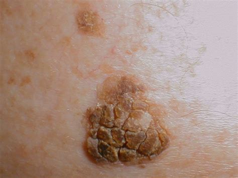 Collection Of Dark Scaly Spots On Skin Actinic Keratosis