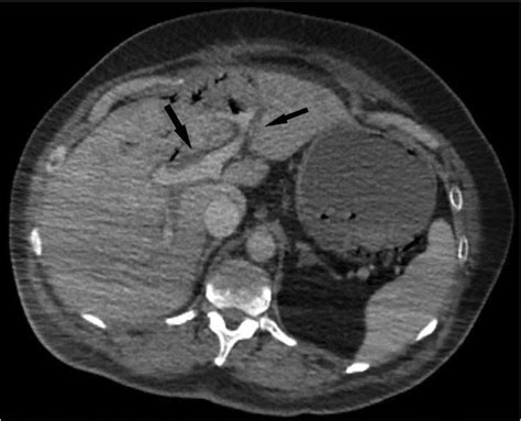 Contrast Enhanced Axial Ct Scan Of The Abdomen In The Portal Venous