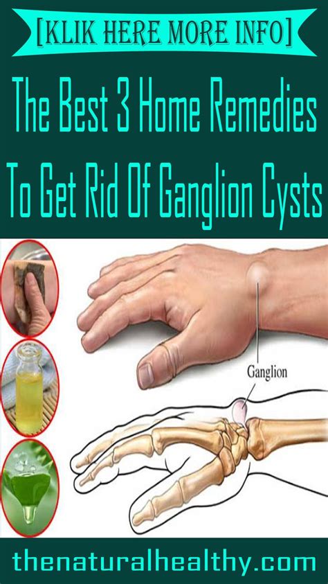 Get Rid Of Ganglion Cyst Naturally Wifje