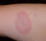 Lyme Disease Rash Itch Treatment
