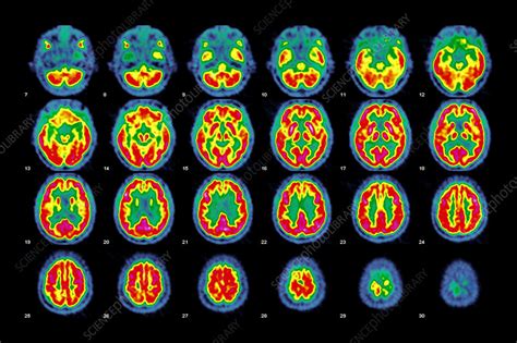 Normal Brain Activity Pet Scans Stock Image C0267614 Science