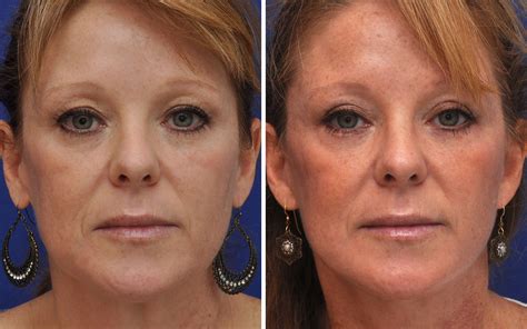 Eyelid Surgery Before And After Photos Annapolis Md