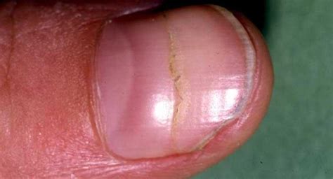 Type 2 Diabetes Nails Diabetestalknet