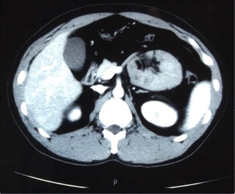 Para Duodenal Hernia A Report Of Five Cases And Review Of Literature