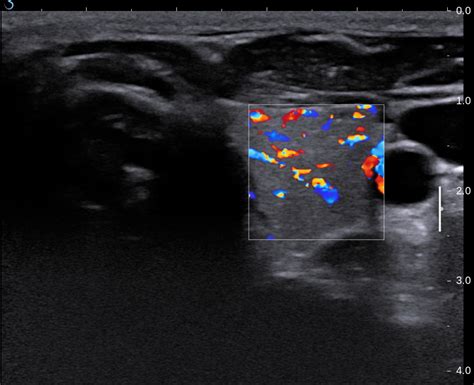 Vietnamese Medic Ultrasound Case Calcified Thyroid Tumor Dr