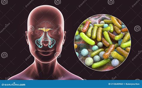 Sinusitis Inflammation Of Paranasal Cavities Computer Illustration