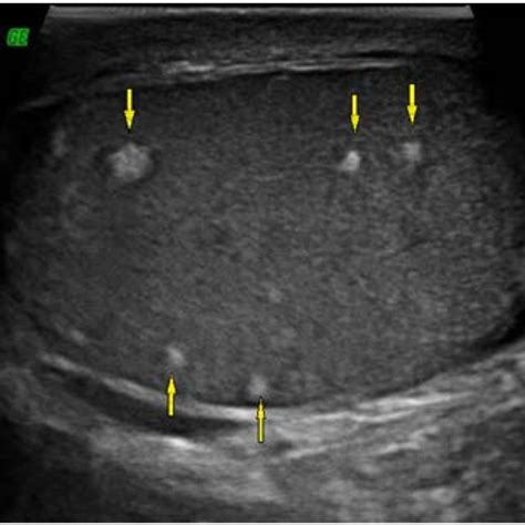 Ultrasound Sagittal View Demonstrate Multiple Ill Defined Hyperechoic