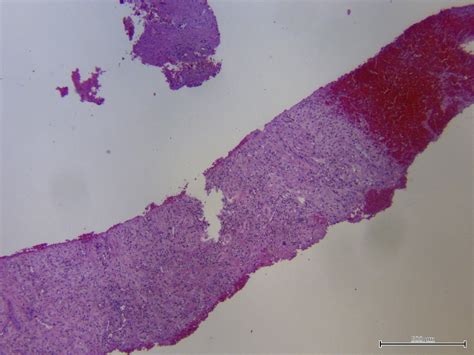 Pathology Outlines Xanthogranulomatous Pyelonephritis Free Hot Nude