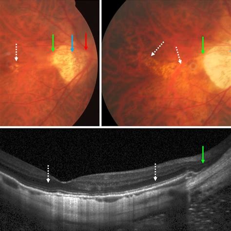 Fundus Photograph Of A Highly Myopic Eye Examined In 2001 Left Image