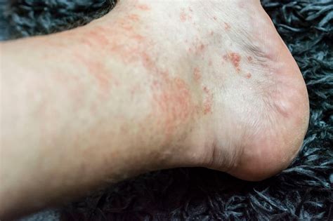 What Type Of Foot Rash Do I Have How To Know The Difference