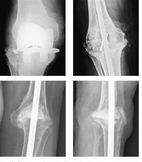 Figure 1 From Knee Arthrodesis With The Vari Wall Nail For Treatment Of