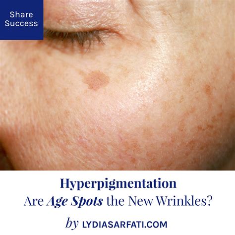 Hyperpigmentation Are Age Spots The New Wrinkles Lydia Sarfati