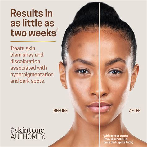 Ambi Skincare Fade Cream For Normal Skin Dark Spot Remover For Face
