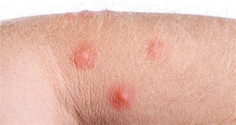 13 Home Remedies For Ant Bites Find Home Remedy And Supplements