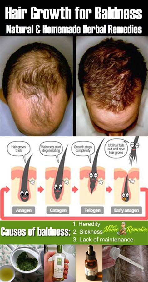 How To Cure Frontal Baldness Naturally A Complete Guide Best Simple