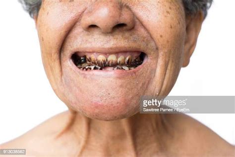 Messed Up Teeth Photos And Premium High Res Pictures Getty Images