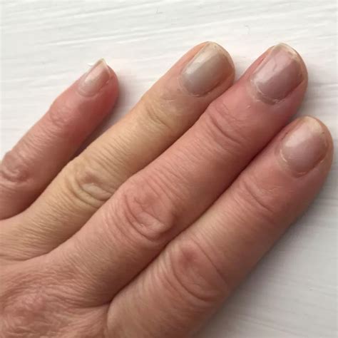 Cold Numb And Painful Fingers And Toes Raynauds Phenomenon Care