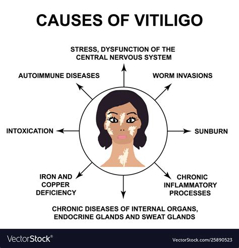 Causes Vitiligo World Vitiligo Day Royalty Free Vector Image