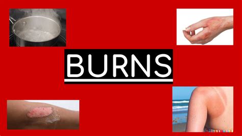 All About Burns Diagram Quizlet