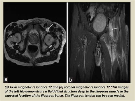 Mri Musculo Skeletal Section Bursa Of Hip Joint