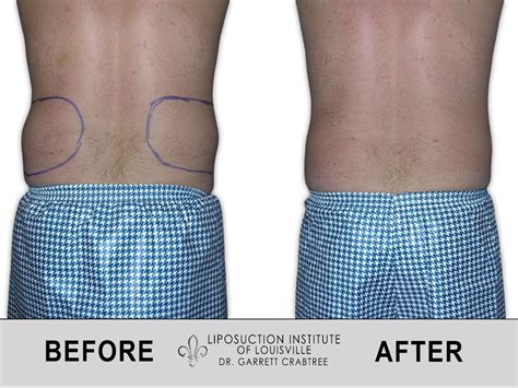 Male Love Handles Before After Gallery Liposuction Institute Of