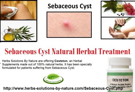 Sebaceous Cyst Natural And Herbal Treatment Herbs Solutions By Nature