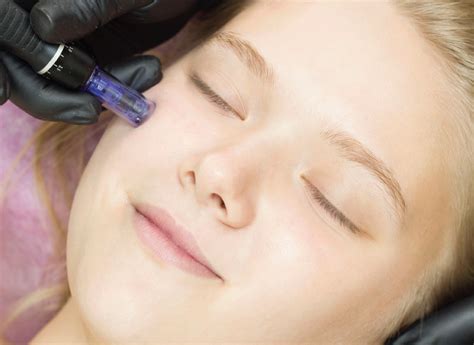 Benefits Of Micro Needling Lipstick Empire Laserspa
