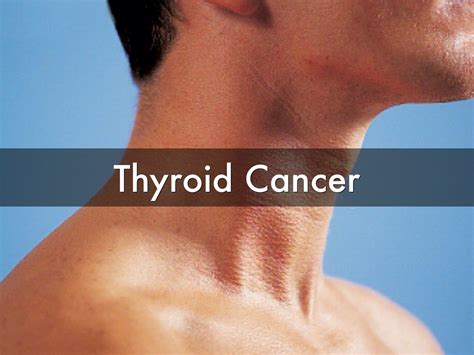 Thyroid Cancer Types Signs Symptoms Stages Treatment