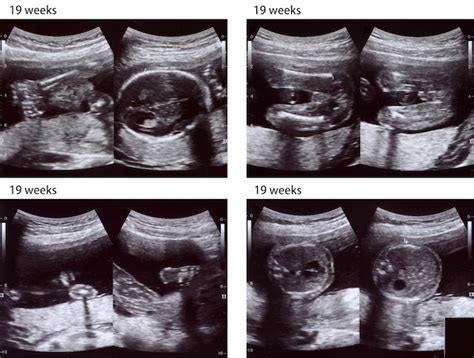 Fetus Head Circumference Ultrasound Microcephaly Calculator