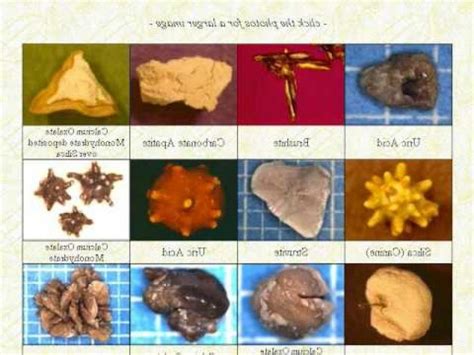 Photos Of Various Types Of Kidney Stones