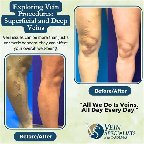 12 Superficial And Deep Vein Procedures Vein Specialists Of The Carolinas