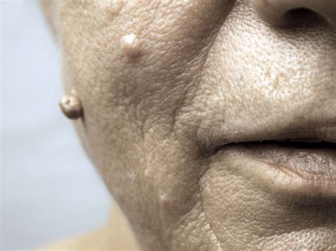 How To Get Rid Of Warts On The Face