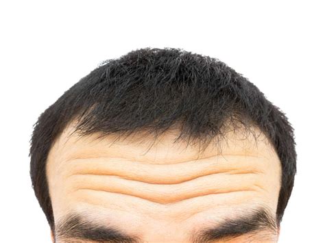 Other factors that cause wrinkles include hormonal changes, photodamage related to excessive exposure to uv radiation from the sun, and habits, such as smoking and alcohol consumption (1). Forehead wrinkles - an early sign of cardiovascular disease?