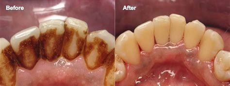 What Is Non Surgical Periodontal Therapy Britten Perio