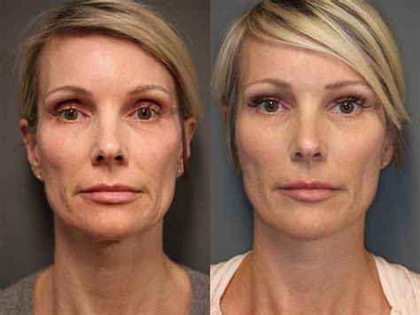 patient 9511902 sculptra before and after clinic 5c