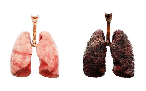 Non Smoker Lungs Vs Smoker
