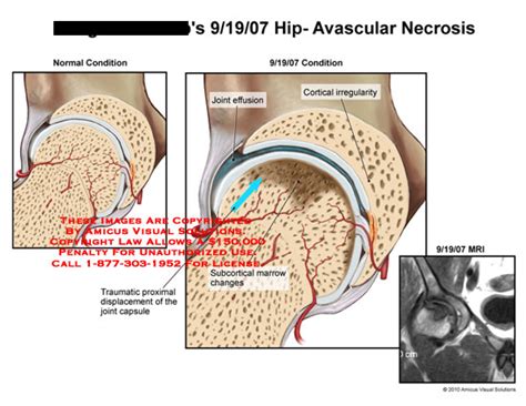 Hip Avascular Necrosis