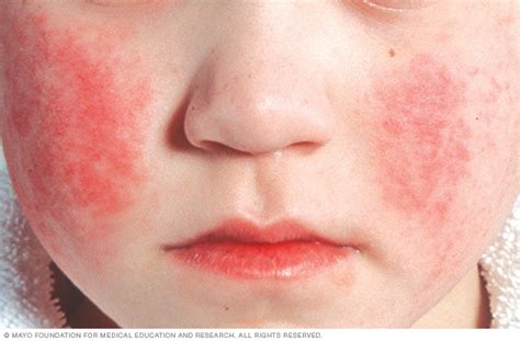 Parvovirus Infection Face Rash Mayo Clinic