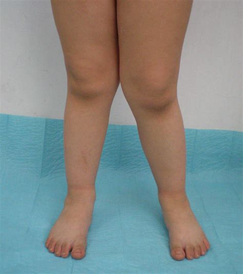 Knock Knees In Children Are Usually Not Treated If The Problem Is