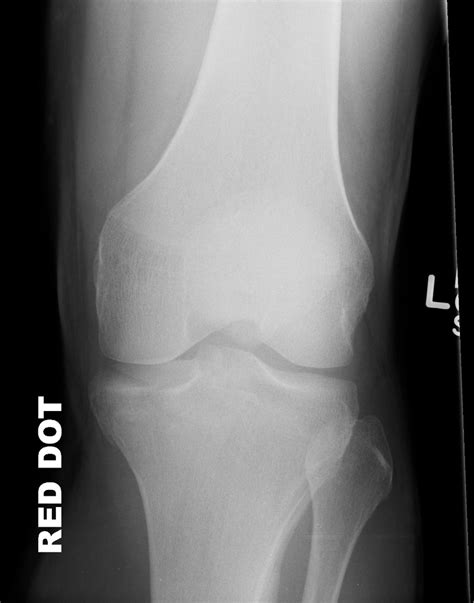 Lateral Tibial Plateau Fracture X Ray
