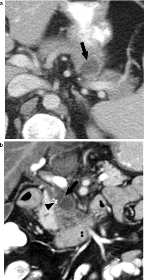 Pancreatic Cysts What Imaging Characteristics Are Associated With