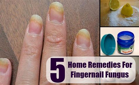 Fingernail Fungus Home Remedy Natural Remedy Treatments And Cure For