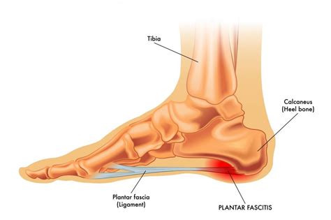Risk factors include limited ankle dorsiflexion, increased body mass. Plantar Fasciitis - What treatments? | The Body Refinery